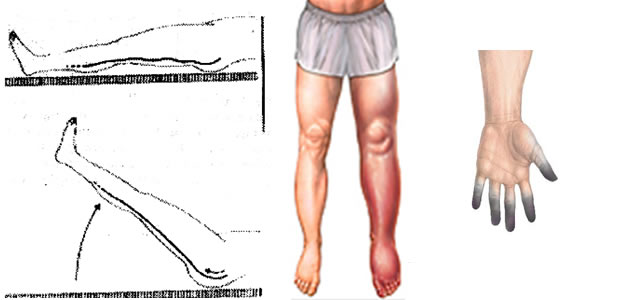 tromboza tromboza