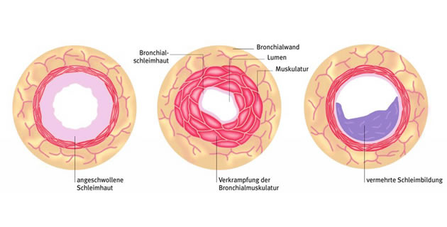 Asthma bronchiale Asthma bronchiale