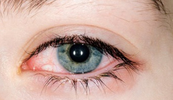 CONJUNCTIVITIS ALLERGICA CONJUNCTIVITIS ALLERGICA
