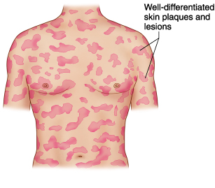 myco_fun Mycosis fungoides