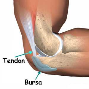 bursitis
