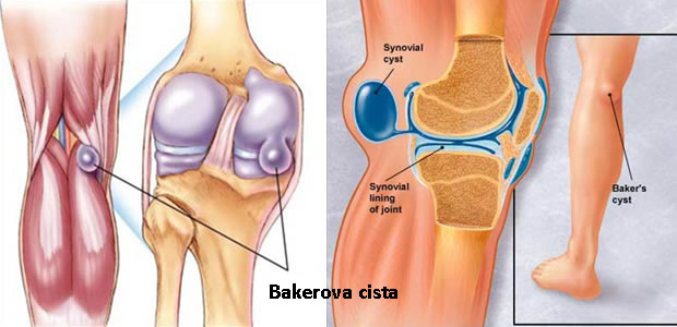 bakerova cista bakerova cista