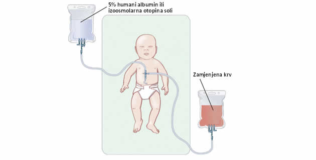 Policitemija novorođenčeta Policitemija novorođenčeta