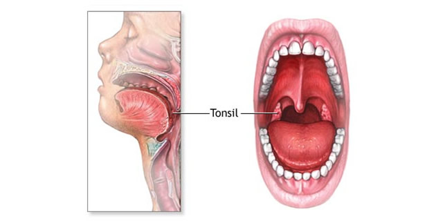 Akutni adenoiditis Akutni adenoiditis