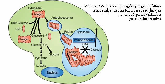 Pompeova bolest Pompeova bolest