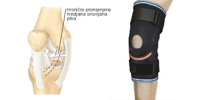 Sindrom sinovijalnog nabora Sindrom sinovijalnog nabora