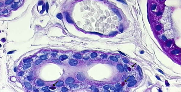 Laforaova bolest Laforaova bolest