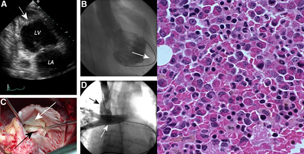 Loefflerov endokarditis Loefflerov endokarditis