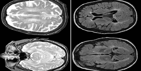 Neimann-Pickova bolest Neimann-Pickova bolest
