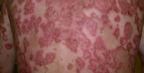 Pemphigus vulgaris Pemphigus vulgaris