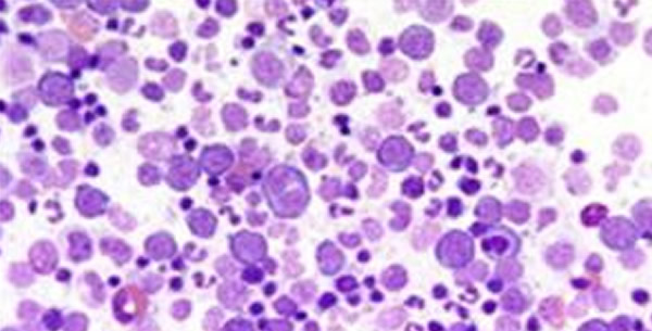 Polycythemia vera Polycythemia vera