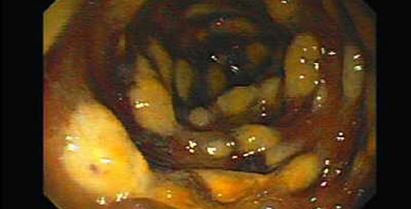 Pseudomembranozni kolitis Pseudomembranozni kolitis