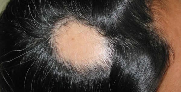 Alopecia areata Alopecia areata