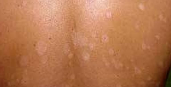 Dermatomikoza Dermatomikoza