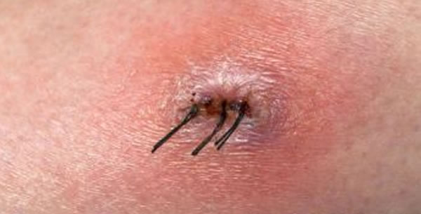 Fistula šava Fistula šava