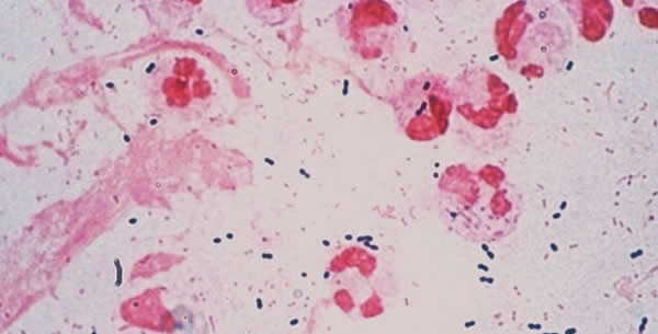 Haemophilus influenzae Haemophilus influenzae