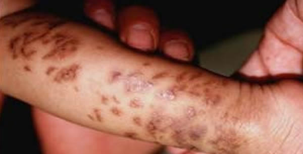 Incontinentia pigmenti Incontinentia pigmenti