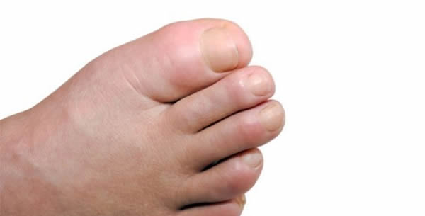 Lymphedema Lymphedema