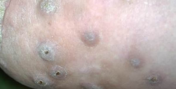 Prurigo nodularis Prurigo nodularis