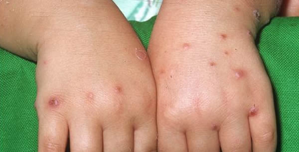 Prurigo simplex acuta infantum Prurigo simplex acuta infantum