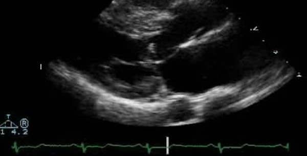 Hipertrofična kardiomiopatija Hipertrofična kardiomiopatija