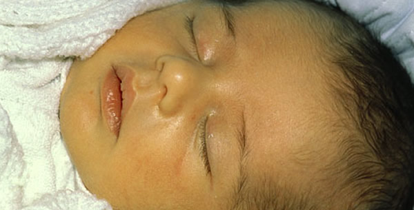 Neonatalni hepatitis Neonatalni hepatitis