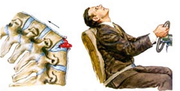 Povreda vratnog dijela kičme Povreda vratnog dijela kičme