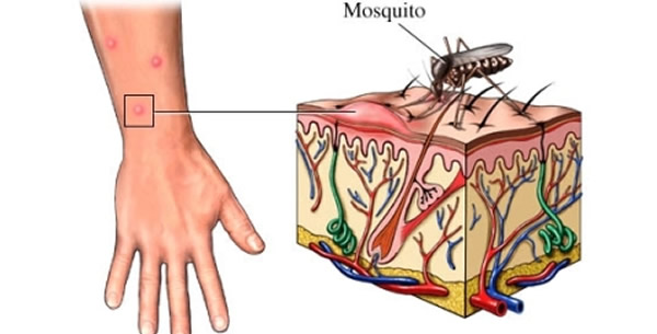 Bolest zapadnog Nila Bolest zapadnog Nila