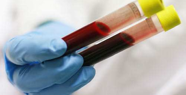 Daunov sindrom Daunov sindrom