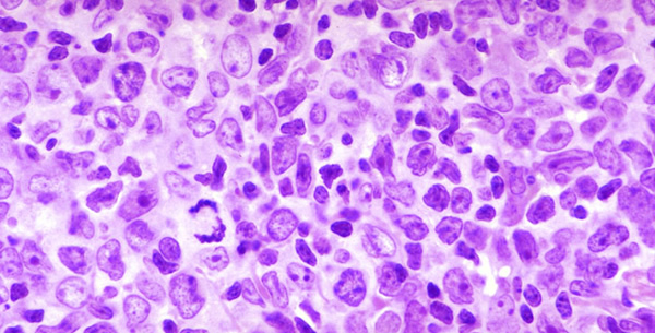 Lymphoma Lymphoma