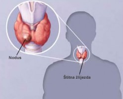 Nodozna toksična struma Nodozna toksična struma